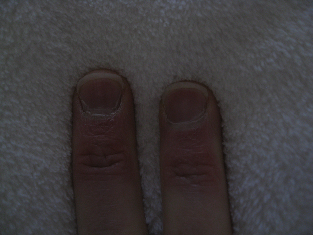 2 grown fingernails